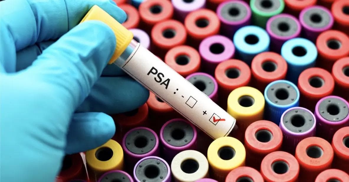 En hand med en labbhandske håller ett test för PSA-värden